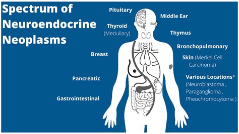 Cancers Free Full Text Pediatric Neuroendocrine Neoplasms Rare