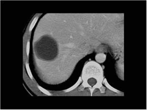 Abdomen And Retroperitoneum Liver Case Hydatid Cysts