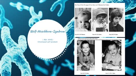 Wolf Hirschhorn Syndrom By Martina S Hl On Prezi