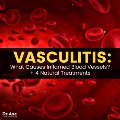 Vasculitis: 4 Natural Treatments for Inflamed Blood Vessels - Dr. Axe