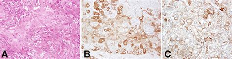 A Microscopic Fi Ndings Of Squamous Cell Carcinoma Scc Case 2 B