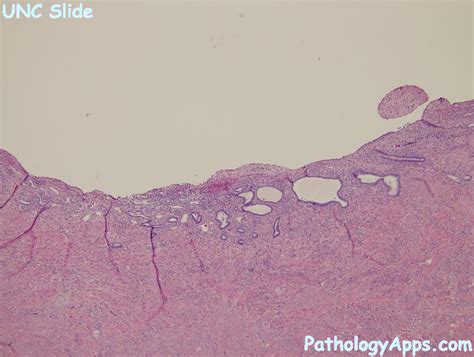 Atrophic Endometrium Pathology