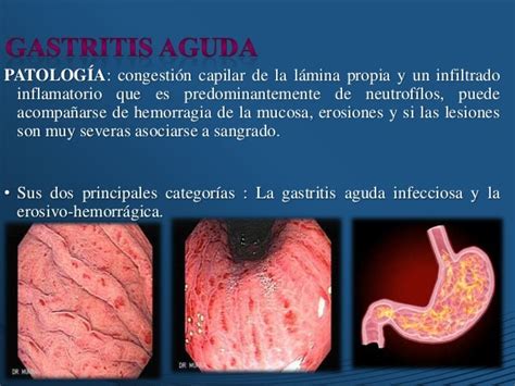 gastritis