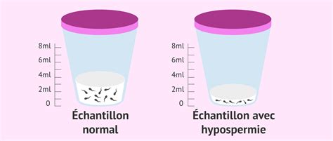 Sperme Jacul Avec Hypospermie