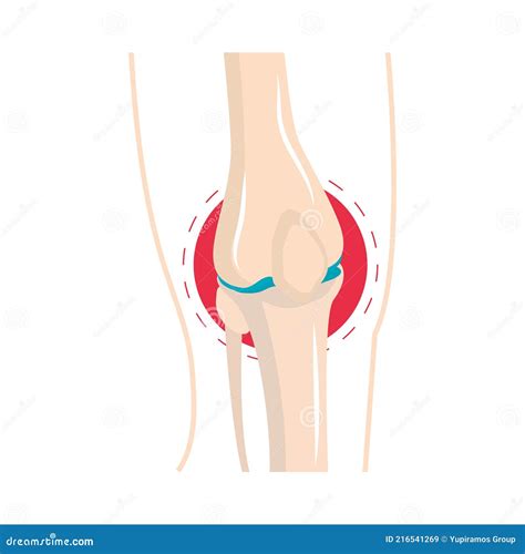 Rheumatism knee swelling stock vector. Illustration of orthopedic