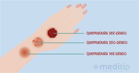 Primeros Auxilios Quemaduras