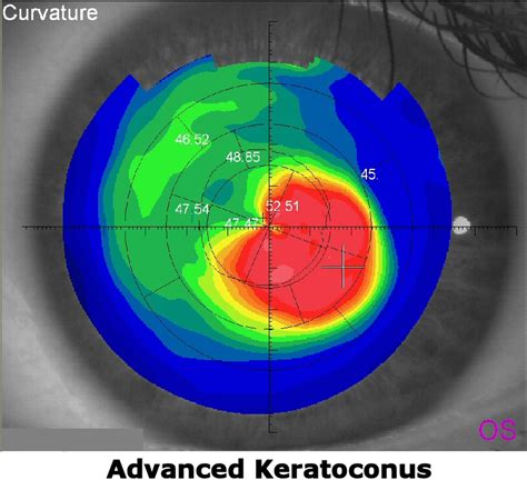 Scleral Contact Lenses For Keratoconus Treatment The Eye Doc Blog