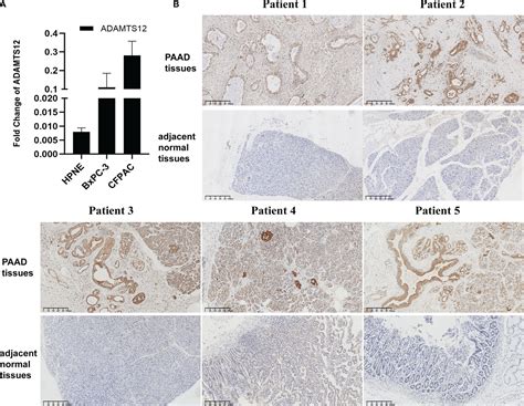 Frontiers An Integrated Pan Cancer Analysis Of Adamts And Its