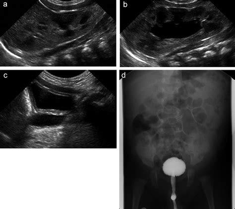 Meaning Of Ureter Dilatation During Ultrasonography In Infants For