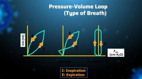 VENTILATOR ASYNCHRONY pathophysiology and clinical relevance | PPT