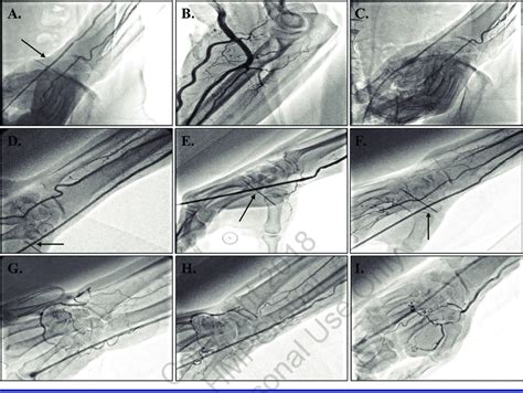 Angiography Of The Left Radial Artery At The Level Of The Wrist A Download Scientific