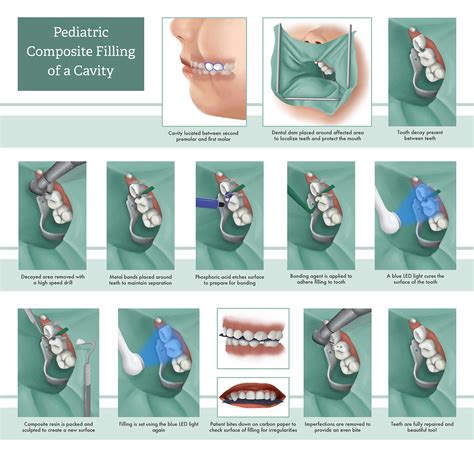 Composite Cavity Filling on Behance