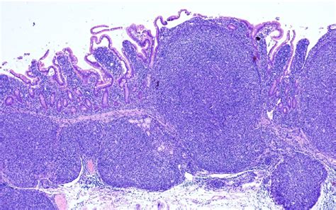 Duodenal Type Follicular Lymphoma Hande ×40 Low Magnification Shows Download Scientific