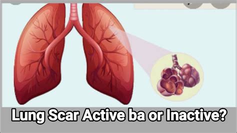 Lung Scar Active Ba Or Inactive Youtube