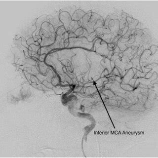 Ct Angiogram Showing Inferior Middle Cerebral Artery Aneurysm Mca