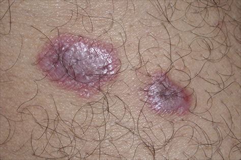 Dermoscopy Subpatterns of Inflammatory Skin Disorders | Dermatology ...