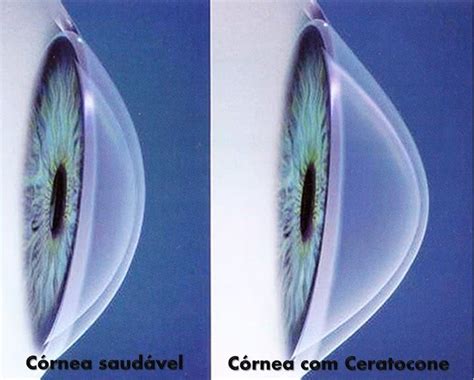 Crosslinking Alternativa Segura Para Tratamento Do Ceratocone