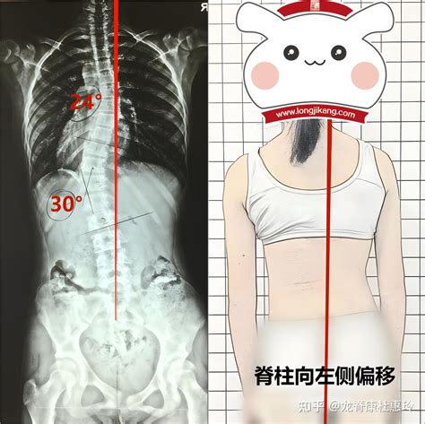 S型脊柱侧弯，一定要戴长支具矫形吗？此文告知您 知乎