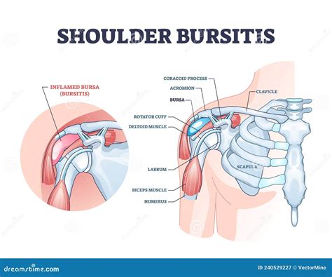 Shoulder Bursitis As Medical Painful Bursa Inflammation Outline Diagram