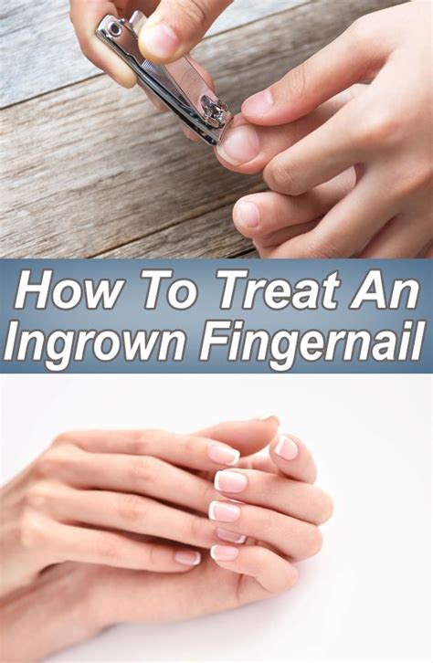 How To Treat An Ingrown Fingernail Ingrown Fingernail Fingernails