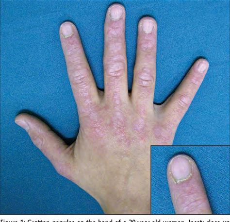 Figure From Gottron Papules A Pathognomonic Sign Of Dermatomyositis