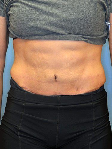 Tummy Tuck Before and After Photos