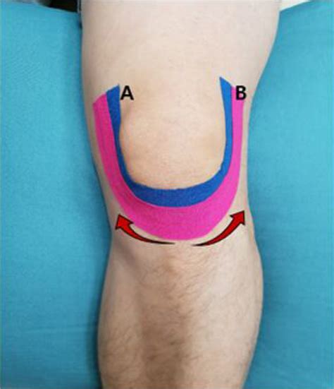 Immediate Effect Of Patellar Kinesiology Tape Application On Quadriceps