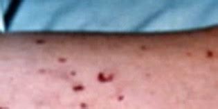 Meningitis – Rash Pictures, Causes, Symptoms, Treatment – Inside the Clinic