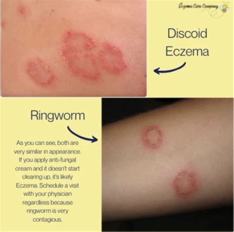 Common Dermatological Conditions With A High Psychological Impact