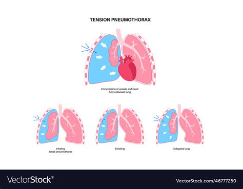 Tension Pneumothorax Poster Royalty Free Vector Image