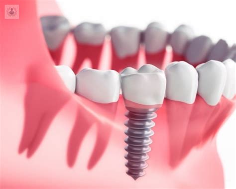 Beneficios De Los Implantes Dentales De Carga Inmediata Top Doctors