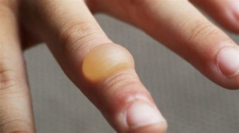 How long does it take a burn blister to heal? - Live2Long.com