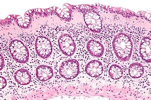 Collagenous colitis - Libre Pathology