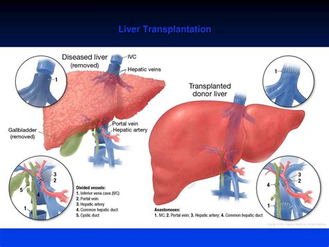 PPT - Liver Transplant: Decompensated Cirrhosis Impact on Survival