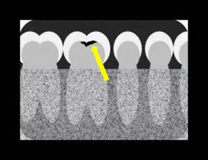 Caries Interpretation: Occlusal Caries – Dr. G's Toothpix