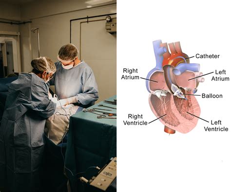 Balloon Valvuloplasty, Mitral /Pulmonary Aortic – Heart Center Ranchi