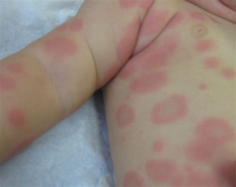 Erythema Multiforme Target Lesions