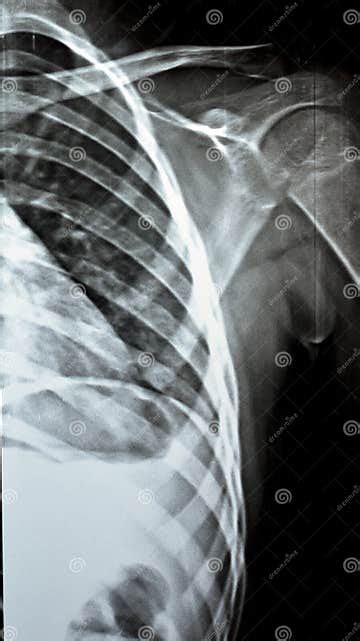 Plain X Ray Pxr Of Left Shoulder Of Skeletally Immature Female Patient