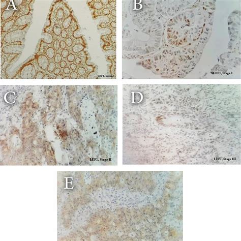 Immunohistochemistry staining of EGFR marker in normal colon and stages ...