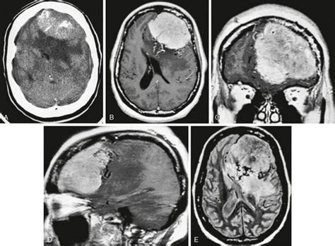 Meningeal Neoplasms Radiology Key