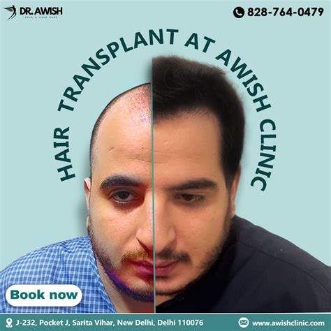 Fue Hair Transplant Treatment Natural Hair Restoration Awish Clinic