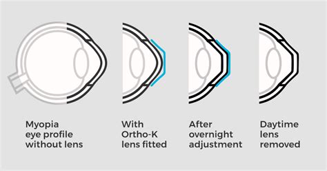 Ortho K Technology Toronto Orthokeratology Treatment And Lenses