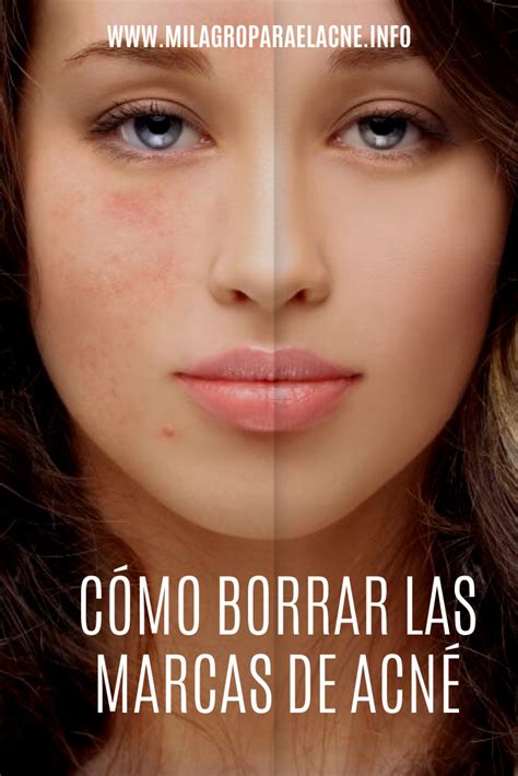 Cómo Borrar Las Marcas De Acné Tratamiento Efectivo Acne Marks