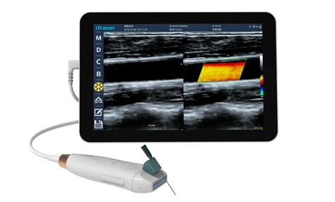 Ultrasound-guided Radial Artery Puncture – Handheld POC Ultrasound System