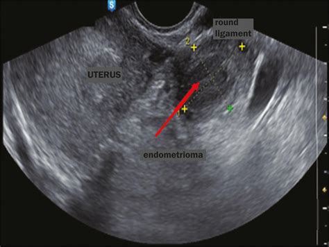 Scielo Brasil Transvaginal Ultrasound In Deep Endometriosis