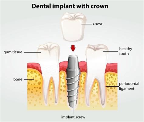 Dental Implants Gurgaon