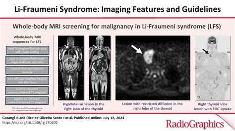 Li Fraumeni Syndrome Imaging Features And Guidelines Radiographics