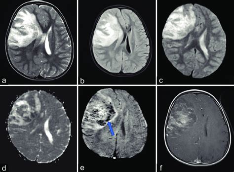 A Plain Mri T2 Axial And B T2 Flair Image Showing Hyperintensity In