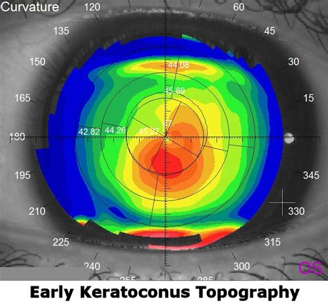 Keratoconus Education Diagnosis And Treatment