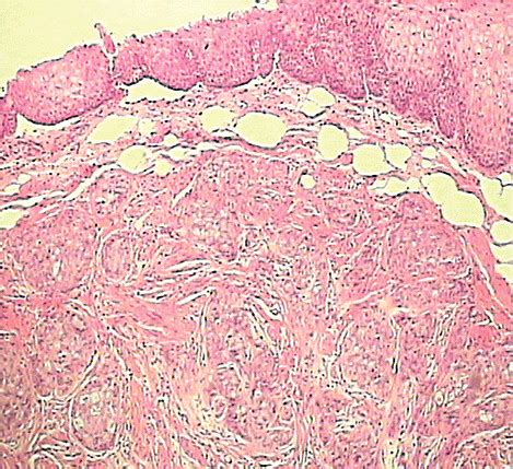 Histological Examination Of The Specimen Obtained By Endoscopic Mucosal